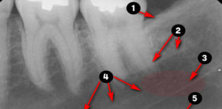 Periapical Radiographic landmarks - Quiz