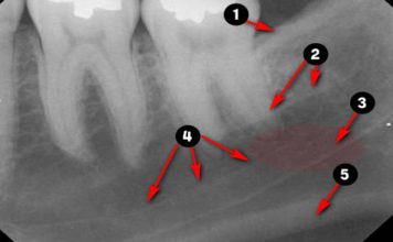 Periapical Radiographic landmarks - Quiz