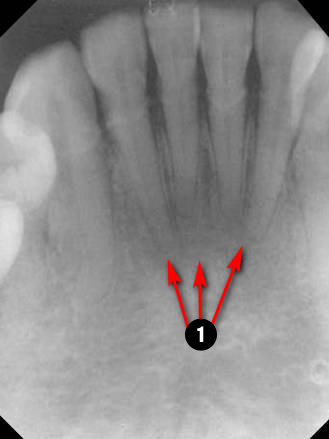 mandibular-Incisor2q